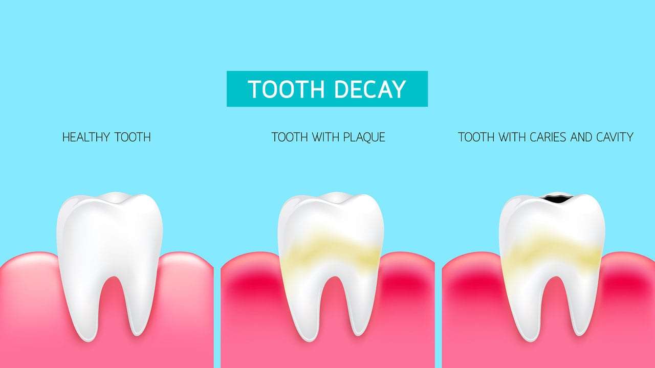 Cavity Treatment